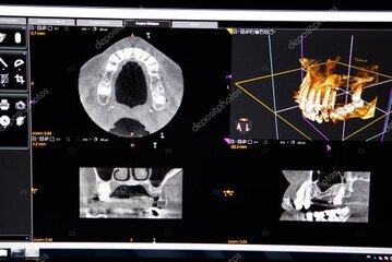 CT画像とインプラント計画のイメージ