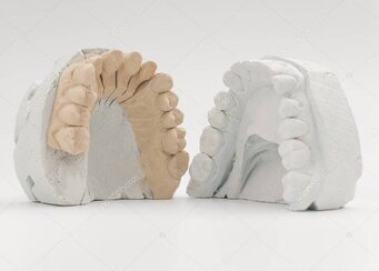 インプラントとブリッジのイメージ比較