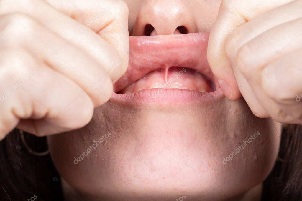 小帯切除のイメージ