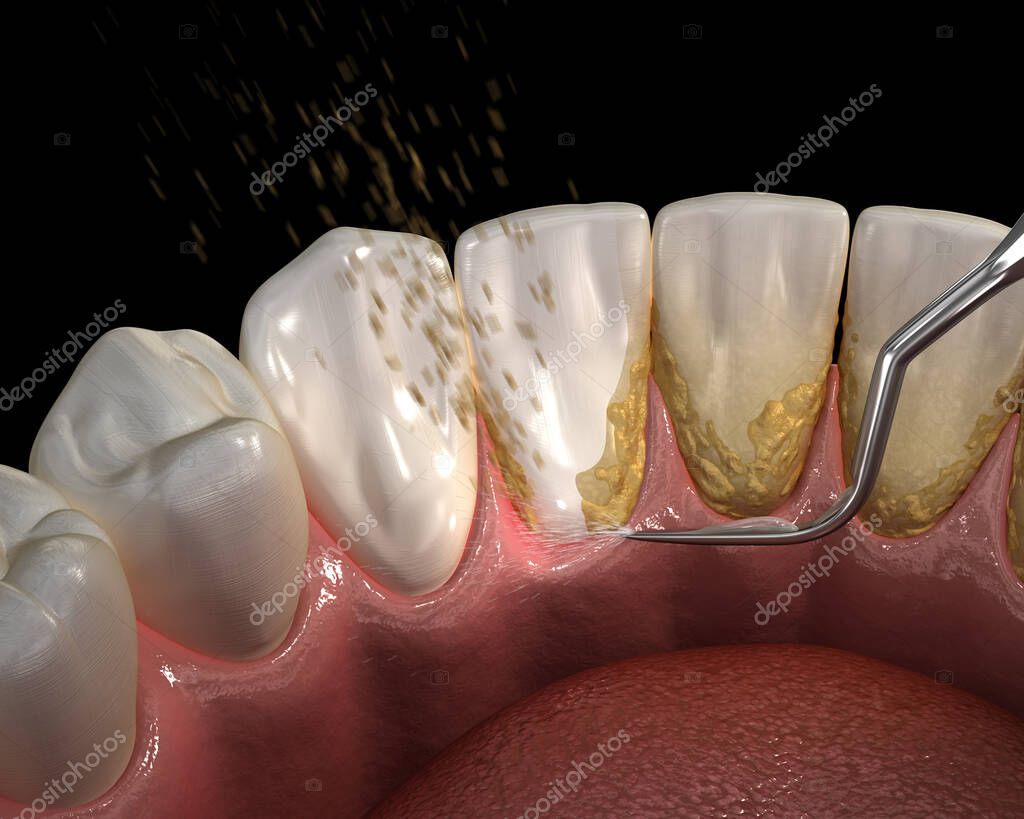 スケーリングで歯石を取るイメージ