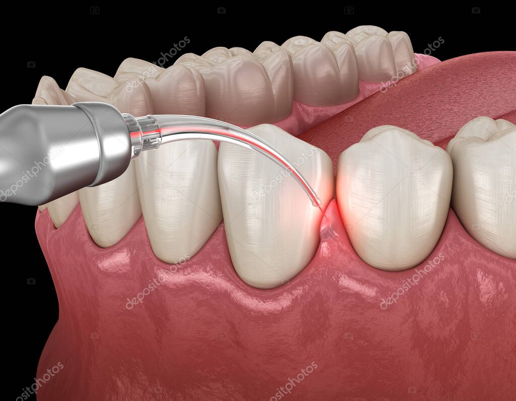歯周ポケット処置のイメージ